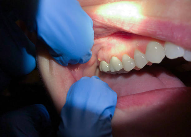 Best Emergency Treatment for Dental Infections or Abscesses in West Point, GA